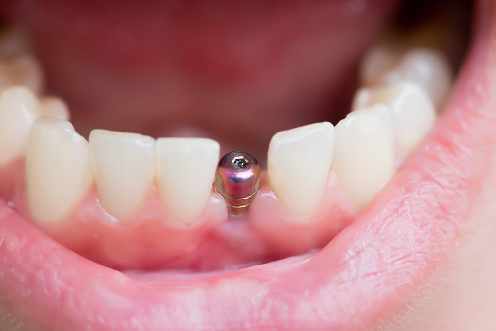Can Dental Implants Get Infected? | Central Periodontics