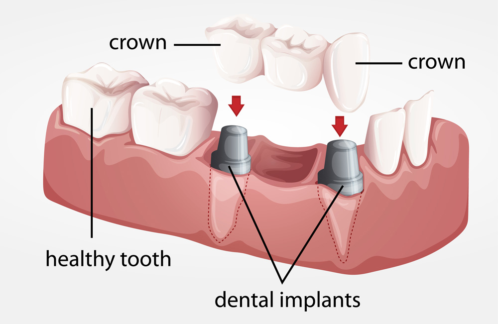 How Long Does The Dental Implant Process Take | Periodontics