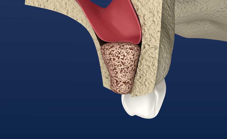 Bone Grafting & Sinus Lifts for Dental Implants | Central Periodontics Canberra